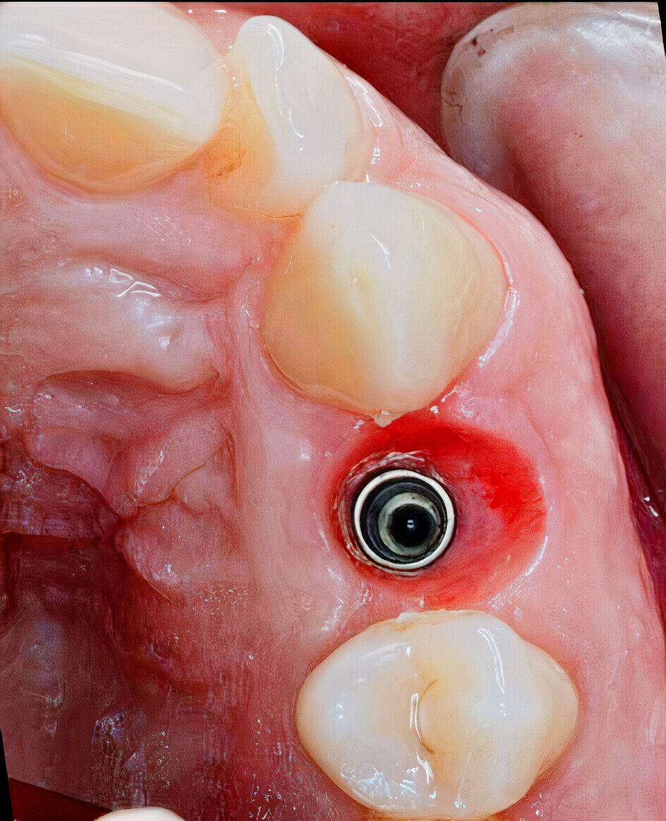 NEP Natural Emergence Profiler, Dental Implant, New Perspective, New Idea..